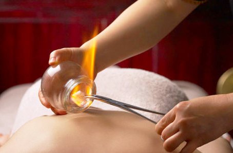 Image result for fire cupping